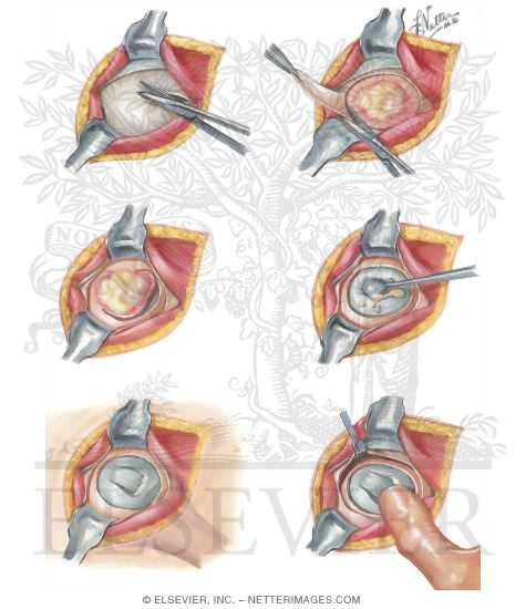 Watermarked preview of unlabeled image: Technical Steps For Bursa And Deposit