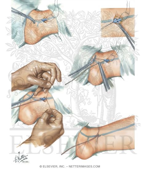 Watermarked preview of unlabeled image: Catheterization Of Saphenous - View II