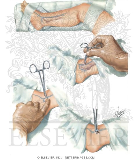 Watermarked preview of unlabeled image: Catheterization Of Saphenous - View I