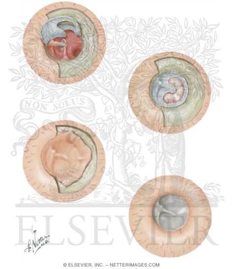 Watermarked preview of unlabeled image: Transmeatal Tympanoplasty