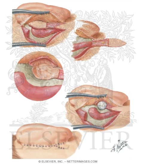 Watermarked preview of unlabeled image: Tympanoplasty And Mastoidectomy