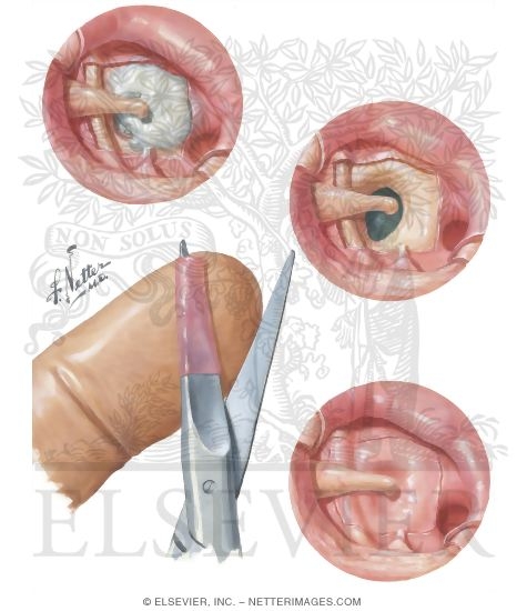 Watermarked preview of unlabeled image: Otosclerosis - Vein Graft