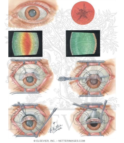 Watermarked preview of unlabeled image: Cataract