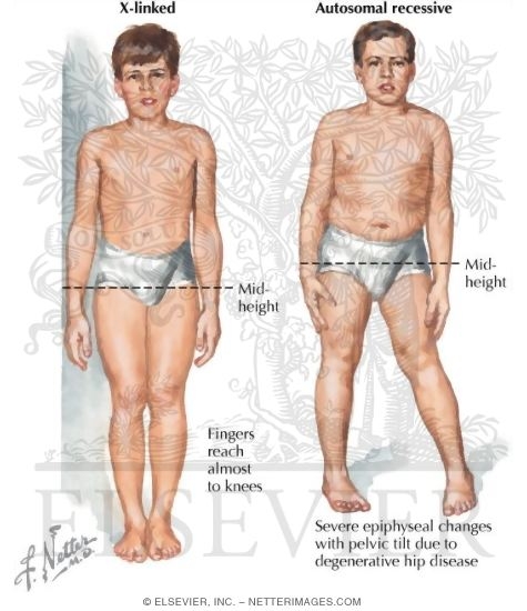 Spondyloepephyseal Dysplasia Tarda