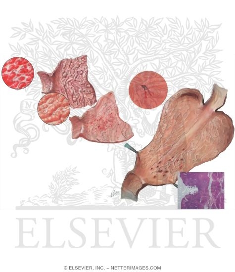 Watermarked preview of unlabeled image: Upper Gastrointestinal (GI) Problems