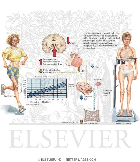 Watermarked preview of labeled image: Osteoporosis Associated with Amenorrhea