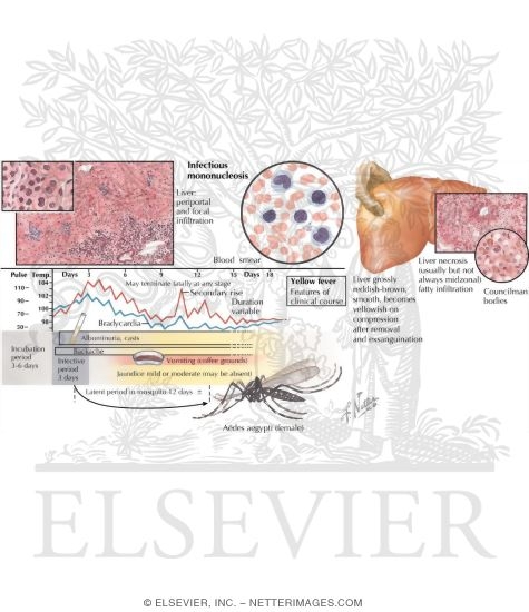 Watermarked preview of labeled image: Infectious Mononucleosis, Yellow Fever