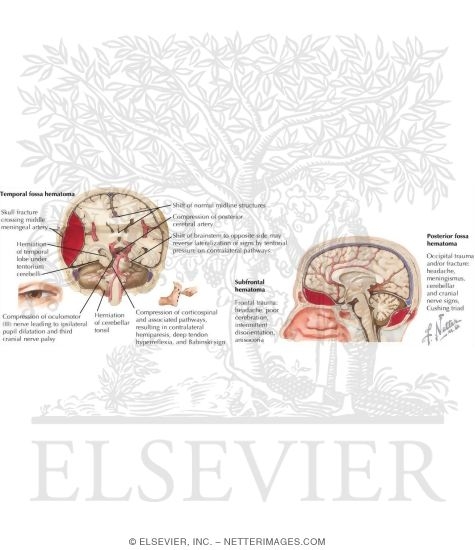 Watermarked preview of labeled image: Epidural Hemorrhage