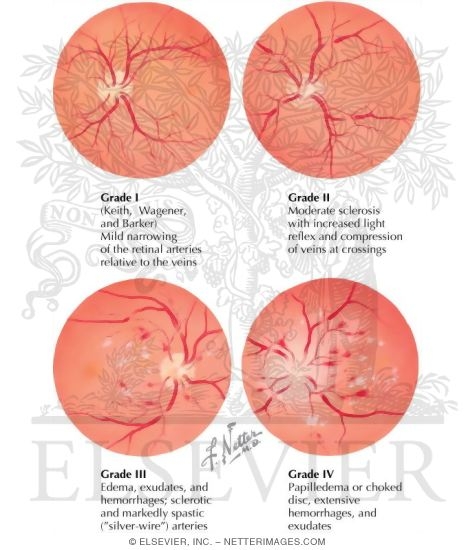 Watermarked preview of labeled image: Eyegrounds in Hypertension