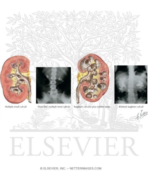 Watermarked preview of labeled image: Renal Calculi