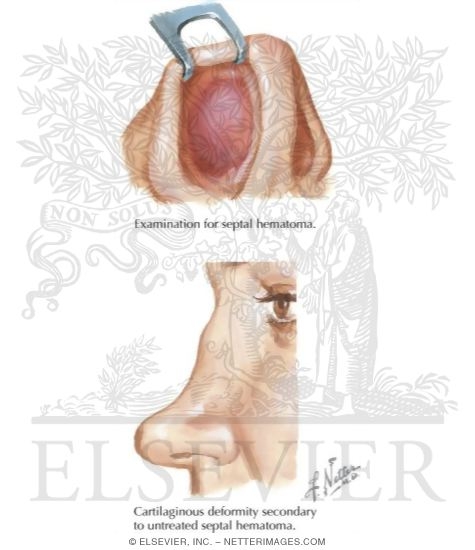 Watermarked preview of labeled image: Nasal Fracture
