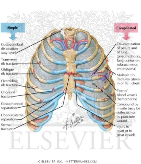 Thoracic Cage Injuries