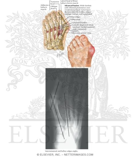 Bunion, Hallux Valgus, and Metatarsus Primus Varus