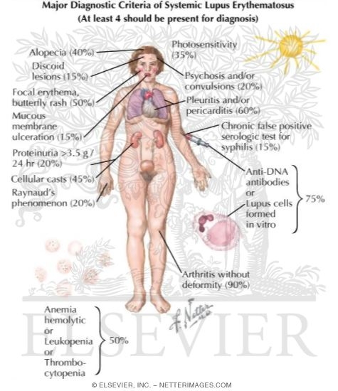 Watermarked preview of labeled image: Major Diagnostic Criteria of Systemic Lupus Erythematosus (SLE)