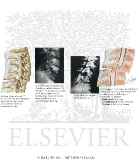 Dislocations of Cervical Spine