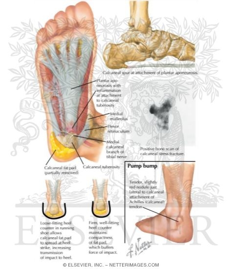 Watermarked preview of labeled image: Plantar Fasciitis