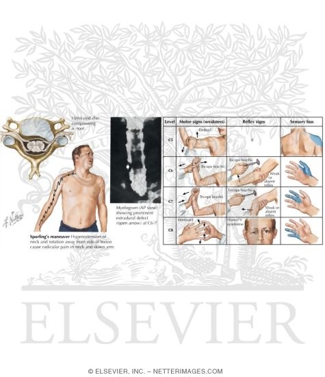 Watermarked preview of labeled image: Cervical Disc Herniation: Clinical Manifestations