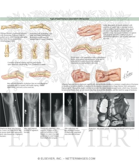 Watermarked preview of labeled image: Special Problems in Fracture of Middle and Proximal Phalanges