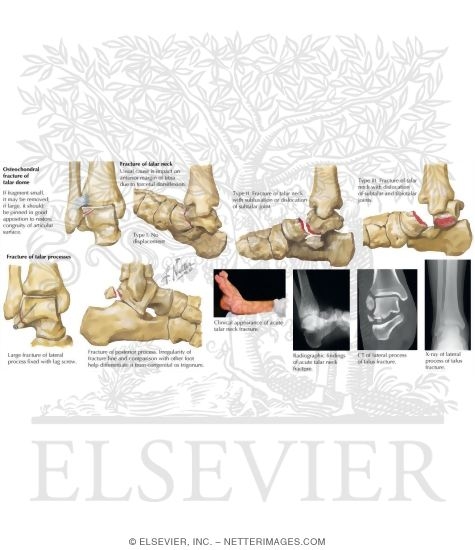 Watermarked preview of labeled image: Fracture of Talus
Fracture of Talar Neck