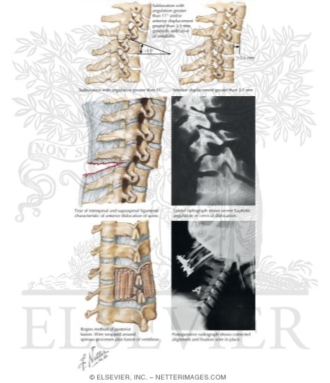 Watermarked preview of labeled image: Subluxation and Ligamentous Instability of Cervical Spine
Trauma
