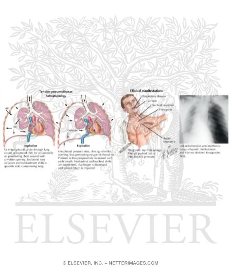 Tension Pneumothorax