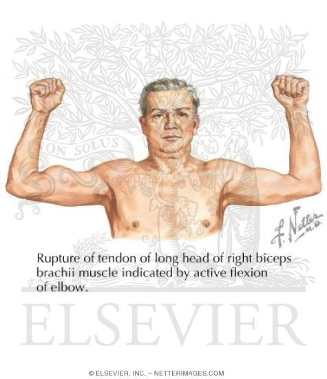 Watermarked preview of labeled image: Rupture of Long Head Biceps Brachii Muscle