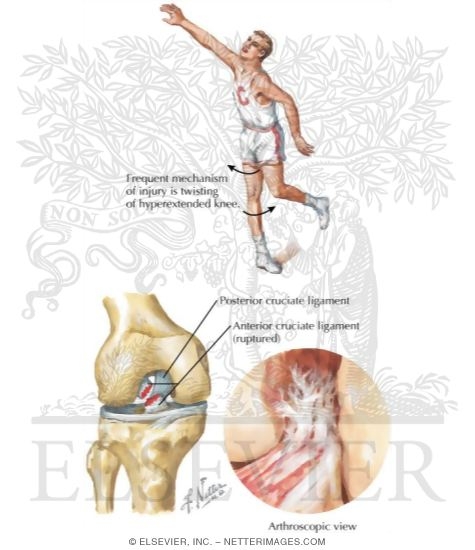 Watermarked preview of labeled image: Rupture of the Anterior Cruciate Ligament