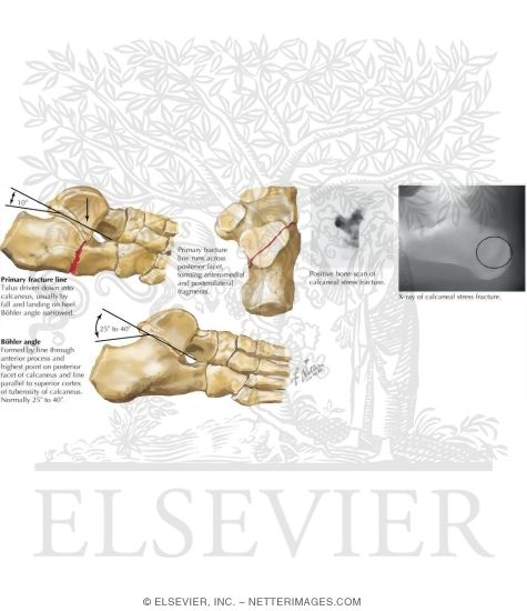 Watermarked preview of labeled image: Intraarticular Fracture of the Calcaneus