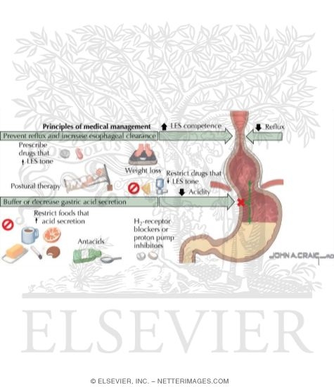 Watermarked preview of labeled image: Gastroesophageal Reflux
