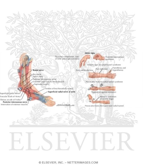 Radial Nerve Compression