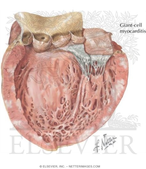 Idiopathic Myocarditis