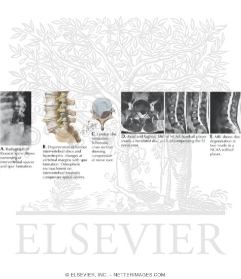 Watermarked preview of labeled image: Degenerative Disc Disease