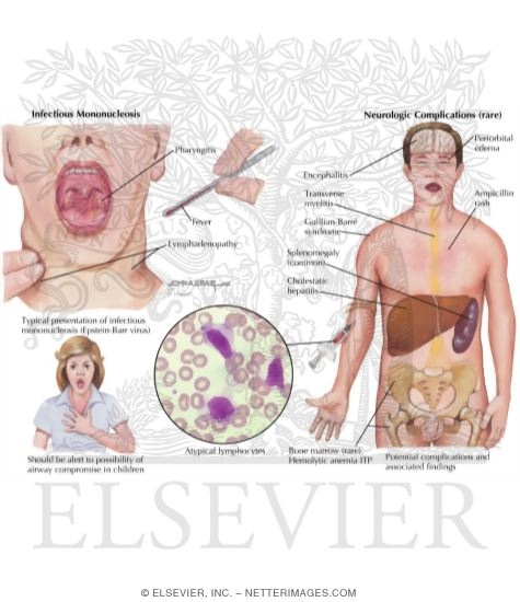 Infectious Mononucleosis
