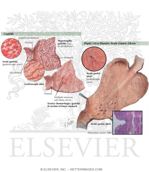 Watermarked preview of labeled image: Upper Gastrointestinal (GI) Problems