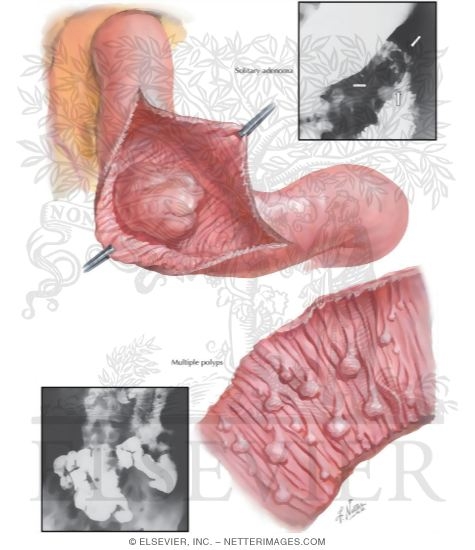 Watermarked preview of labeled image: Benign Tumors of Small Intestine and Peutz-Jeghers Syndrome