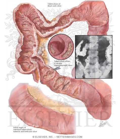 Watermarked preview of labeled image: Intestinal Tuberculosis, Appearance of Mucosa