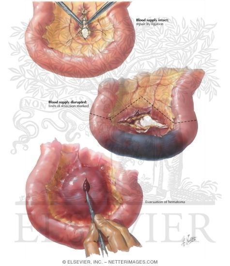 Watermarked preview of labeled image: Abdominal Wounds II - Mesentery