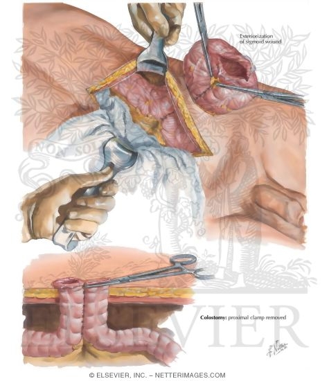 Watermarked preview of labeled image: Abdominal Wounds III - Colon