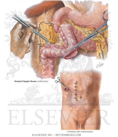 Watermarked preview of labeled image: Abdominal Wounds III - Colon