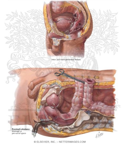 Watermarked preview of labeled image: Abdominal Wounds IV - Rectum