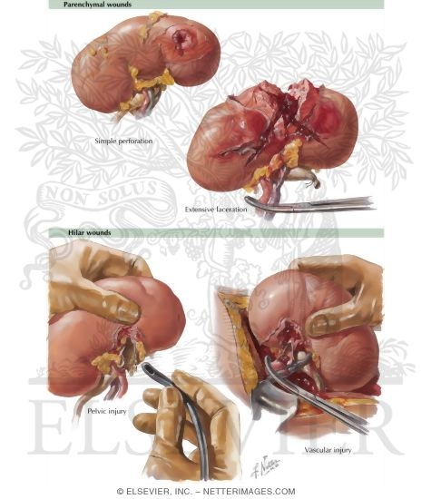 Renal Trauma