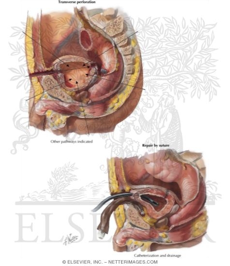Watermarked preview of labeled image: Trauma to the Bladder
