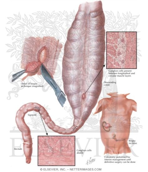 Watermarked preview of labeled image: Aganglionic Megacolon