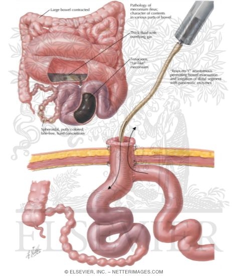 Meconium Ileus