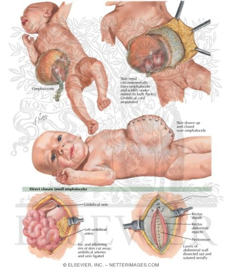 Omphalocele