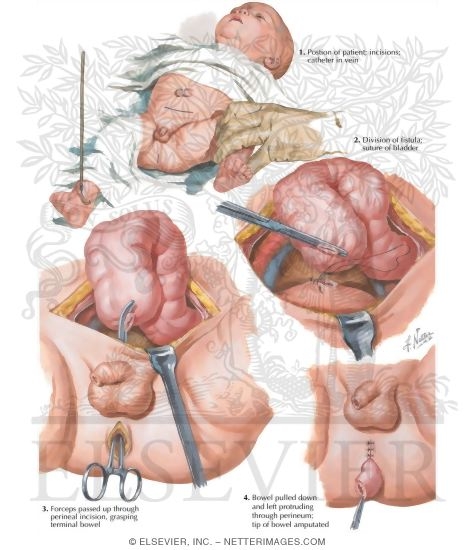 Watermarked preview of labeled image: Abdominoperineal Approach to Imperforate Anus