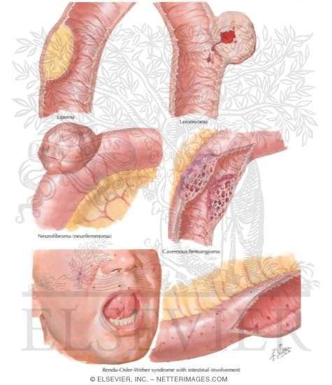 Benign Tumors of Small Intestine