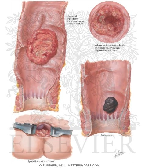 Watermarked preview of labeled image: Malignant Tumors of Large Intestine