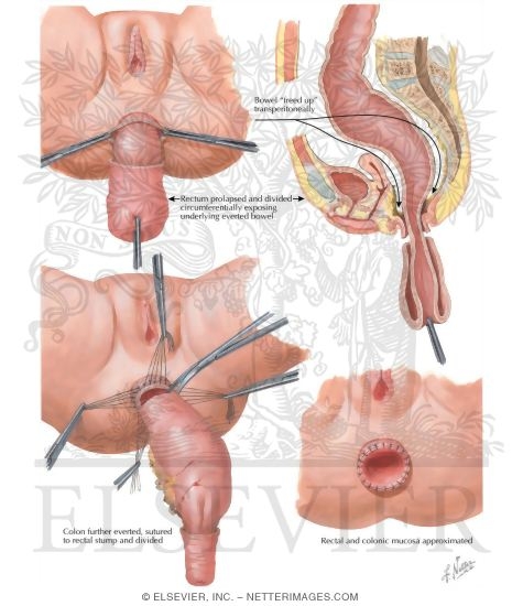 Watermarked preview of labeled image: Congenital Intestinal Obstruction VI - Megacolon (Hirschsprung's Disease)