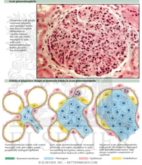 Acute Glomerulonephritis